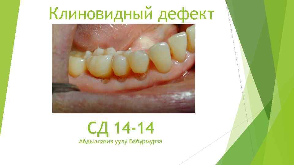 Клиновидный дефект СД 14 -14 Абдыллазиз уулу Бабурмурза 