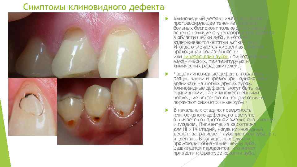 Симптомы клиновидного дефекта Клиновидный дефект имеет медленно прогрессирующее течение. Нередко больных беспокоит только эстетический