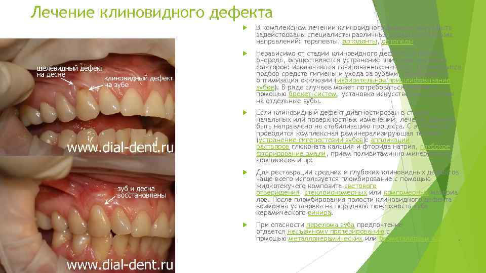 Лечение клиновидного дефекта В комплексном лечении клиновидного дефекта могут быть задействованы специалисты различных стоматологических