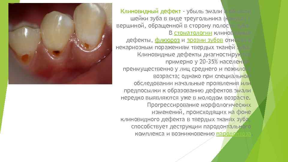 Клиновидный дефект - убыль эмали в области шейки зуба в виде треугольника (конуса) с