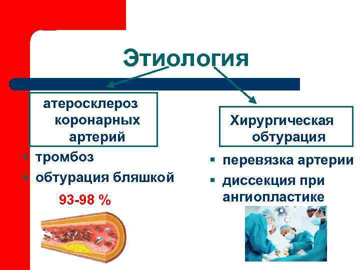 Этиология атеросклероз коронарных артерий § тромбоз § обтурация бляшкой 93 -98 % Хирургическая обтурация