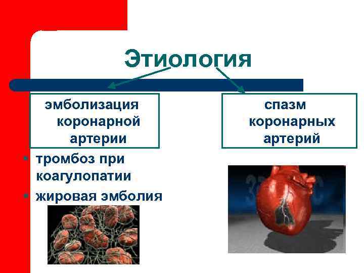 Этиология эмболизация коронарной артерии § тромбоз при коагулопатии § жировая эмболия спазм коронарных артерий