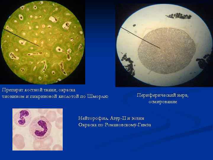 Препарат костной ткани, окраска тионином и пикриновой кислотой по Шморлю Периферический нерв, осмирование Нейторофил.