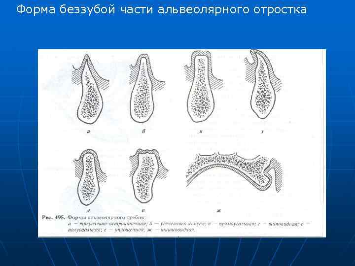 Форма беззубой части альвеолярного отростка 