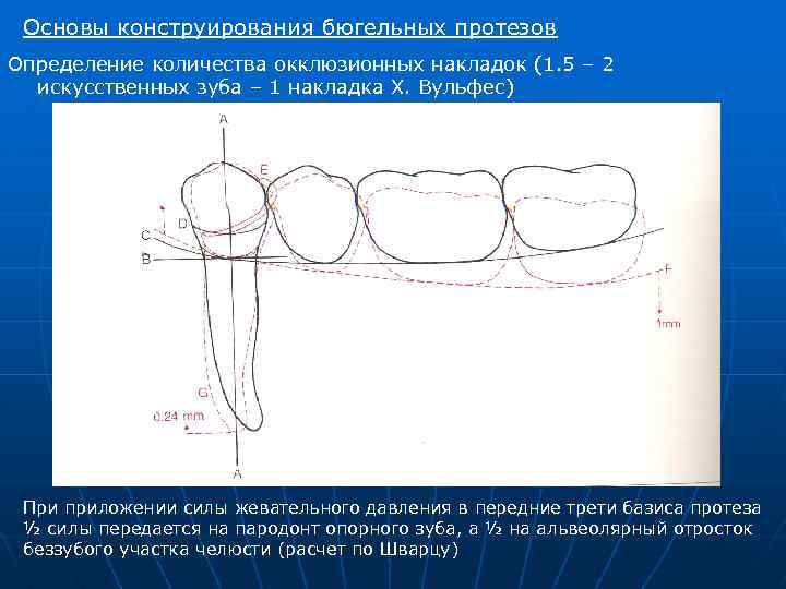 Основы конструирования бюгельных протезов Определение количества окклюзионных накладок (1. 5 – 2 искусственных зуба