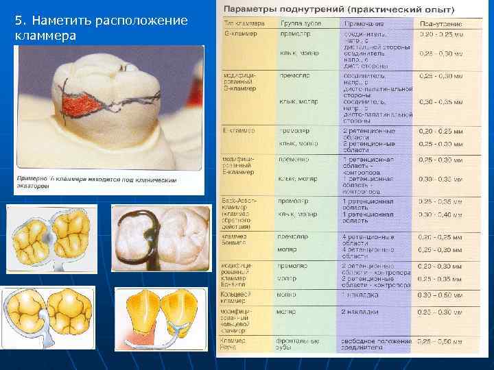 5. Наметить расположение кламмера 
