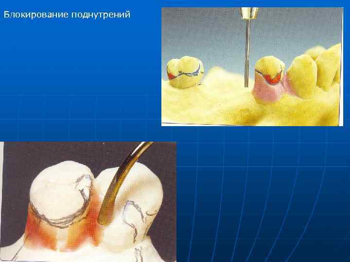 Параллелометрия в стоматологии презентация