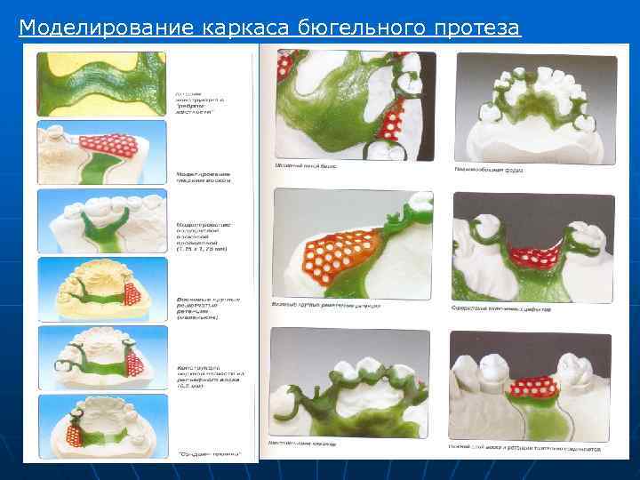 Нанесение чертежа конструкции бюгельного протеза на модели