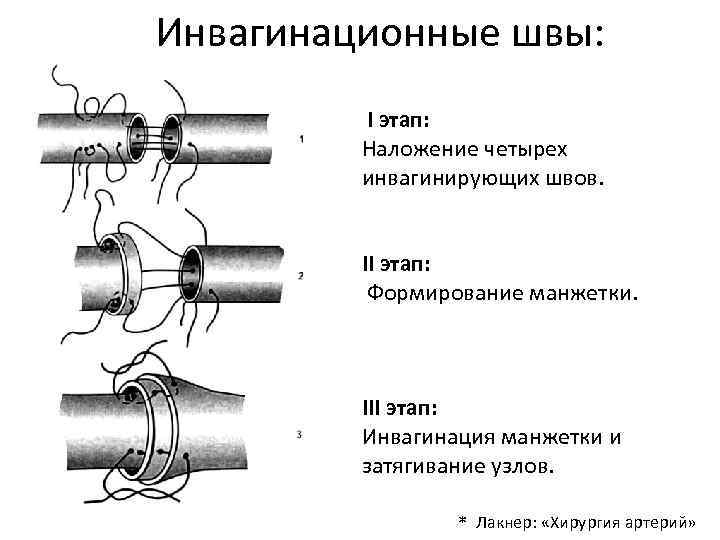 Инвагинационные швы: I этап: Наложение четырех инвагинирующих швов. II этап: Формирование манжетки. III этап: