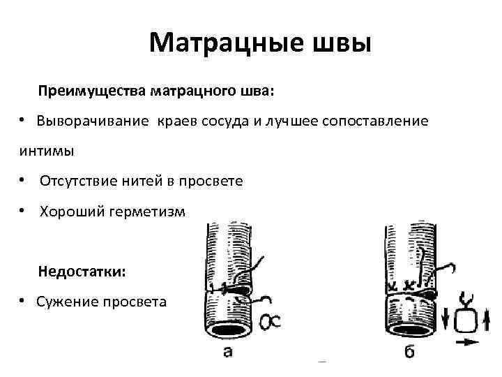 Матрацные швы Преимущества матрацного шва: • Выворачивание краев сосуда и лучшее сопоставление интимы •