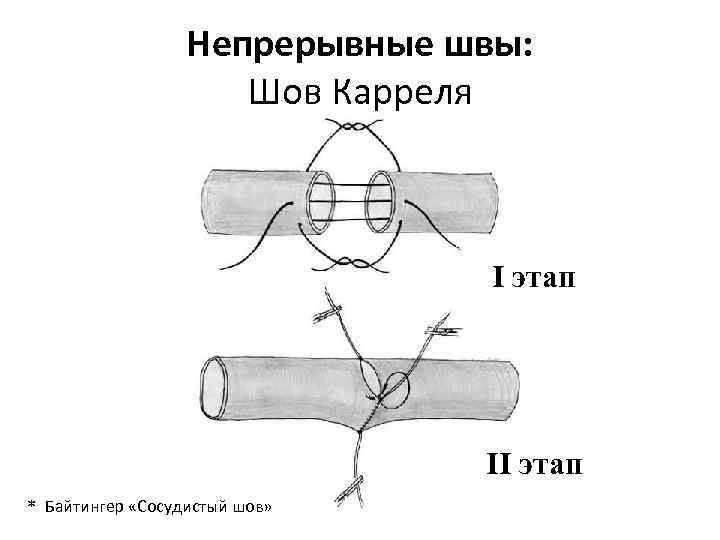 Сосудистый шов история. Сосудистый шов Карреля преимущества. Сосудистый шов по Каррелю и Морозовой. Сосудистый шов инструменты. Сосудистый шов осложнения.