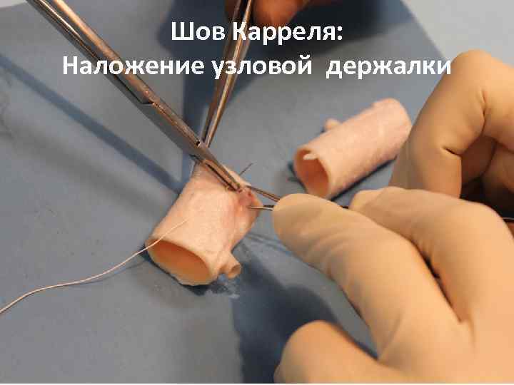 Шов Карреля: Наложение узловой держалки 