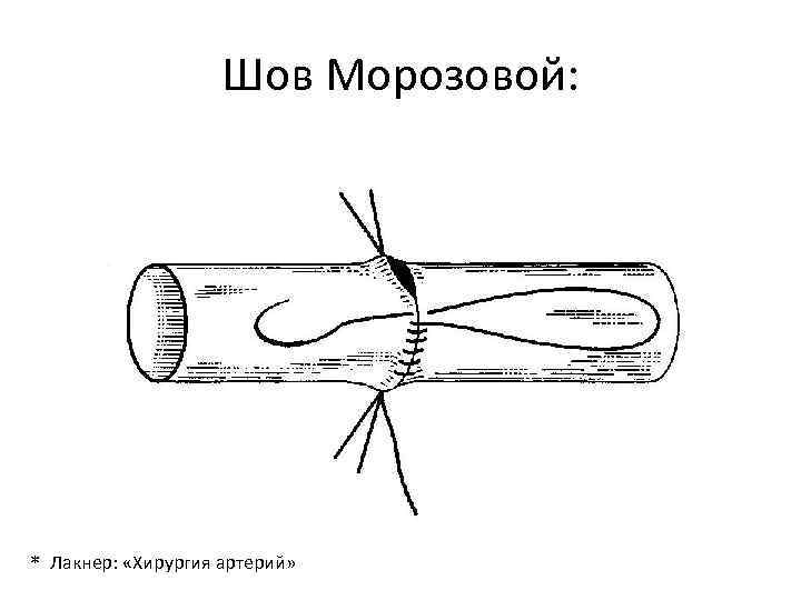 Шов Морозовой: * Лакнер: «Хирургия артерий» 