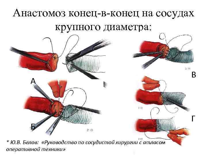 Анастомоз конец-в-конец на сосудах крупного диаметра: А Б * Ю. В. Белов: «Руководство по