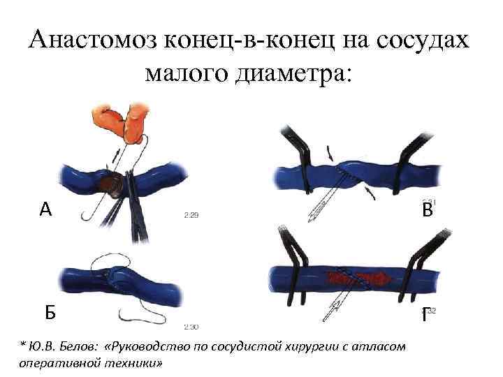 Анастомоз конец-в-конец на сосудах малого диаметра: А В Б Г * Ю. В. Белов: