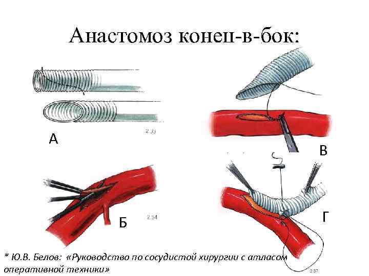 Анастомоз конец-в-бок: А В Б * Ю. В. Белов: «Руководство по сосудистой хирургии с