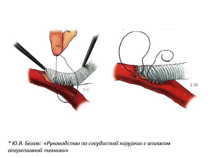 * Ю. В. Белов: «Руководство по сосудистой хирургии с атласом оперативной техники» 