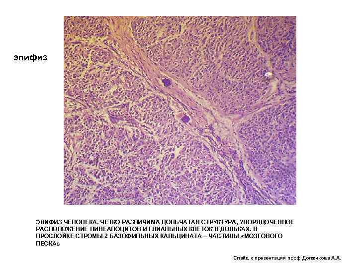 эпифиз ЭПИФИЗ ЧЕЛОВЕКА. ЧЕТКО РАЗЛИЧИМА ДОЛЬЧАТАЯ СТРУКТУРА, УПОРЯДОЧЕННОЕ РАСПОЛОЖЕНИЕ ПИНЕАЛОЦИТОВ И ГЛИАЛЬНЫХ КЛЕТОК В
