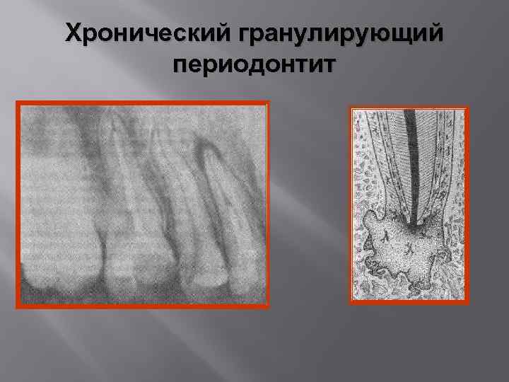 Хронический апикальный периодонтит мкб 10