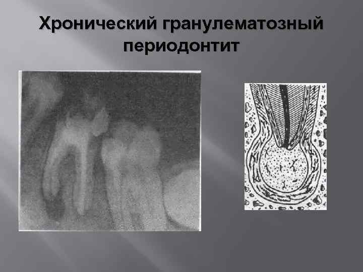 Рентгенологическая картина периодонтита