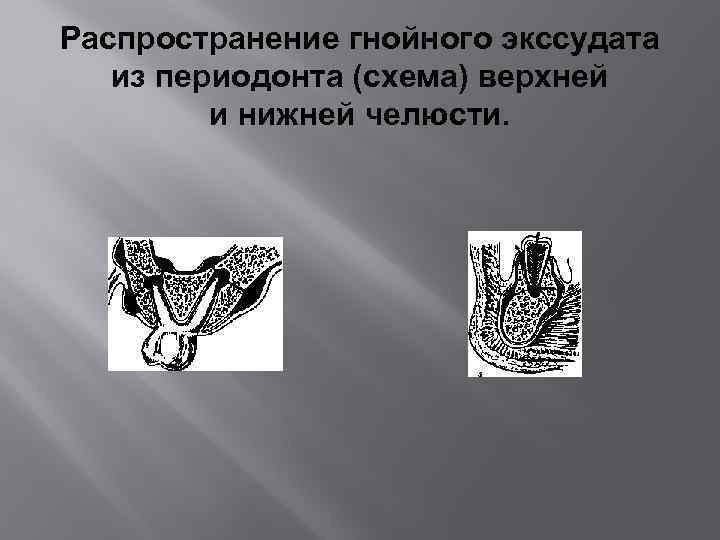 Распространение гнойного экссудата из периодонта (схема) верхней и нижней челюсти. 