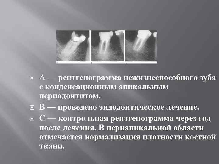  А — рентгенограмма нежизнеспособного зуба с конденсационным апикальным периодонтитом. В — проведено эндодонтическое