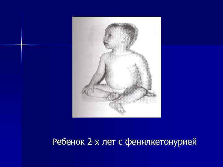 Ребенок 2 -х лет с фенилкетонурией 