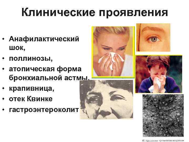 Клинические проявления • Анафилактический шок, • поллинозы, • атопическая форма бронхиальной астмы, • крапивница,