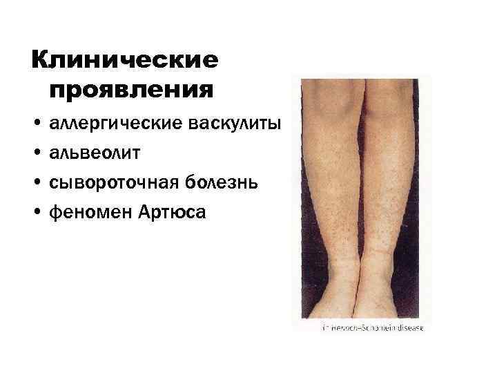Клинические проявления • аллергические васкулиты • альвеолит • сывороточная болезнь • феномен Артюса 