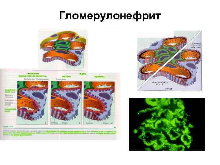 Гломерулонефрит 