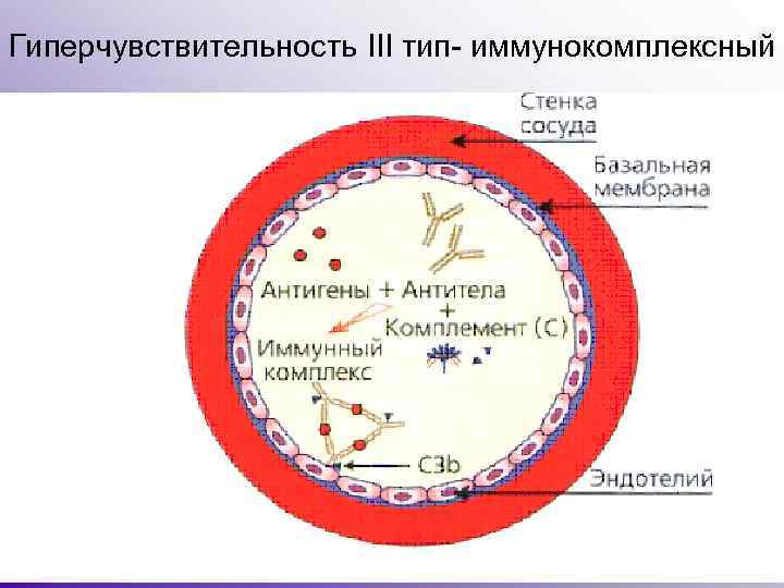 Гиперчувствительность III тип- иммунокомплексный 