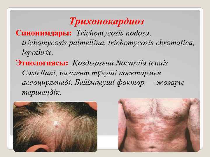 Трихонокардиоз Синонимдары: Trichomycosis nodosa, trichomycosis palmellina, trichomycosis chromatica, lepothrix. Этиологиясы: Қоздырғыш Nocardia tenuis Castellani,