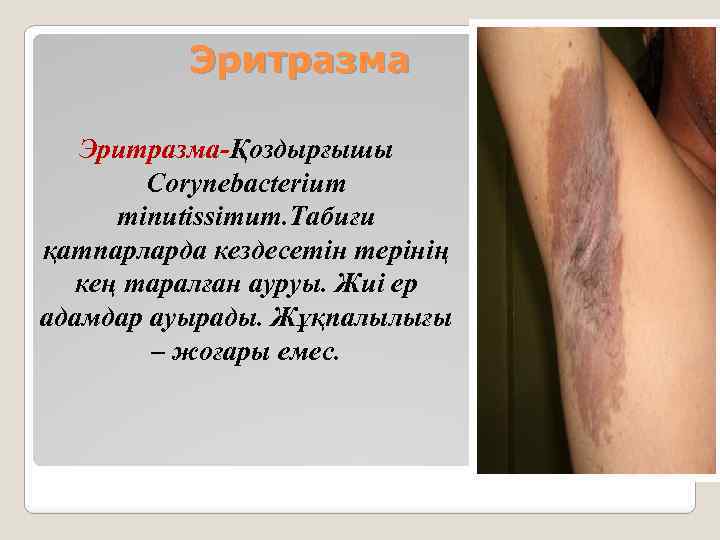 Эритразма-Қоздырғышы Corynebacterium minutissimum. Табиғи қатпарларда кездесетін терінің кең таралған ауруы. Жиі ер адамдар ауырады.