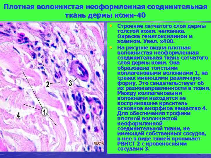 Плотная волокнистая неоформленная соединительная ткань дермы кожи-40 • Строение сетчатого слоя дермы • толстой