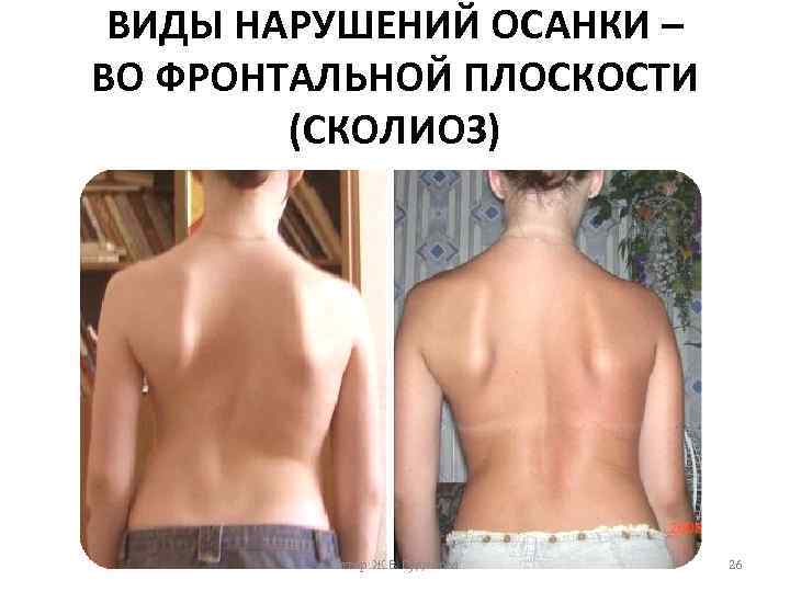 ВИДЫ НАРУШЕНИЙ ОСАНКИ – ВО ФРОНТАЛЬНОЙ ПЛОСКОСТИ (СКОЛИОЗ) Автор: Ж. В. Гудинова 26 