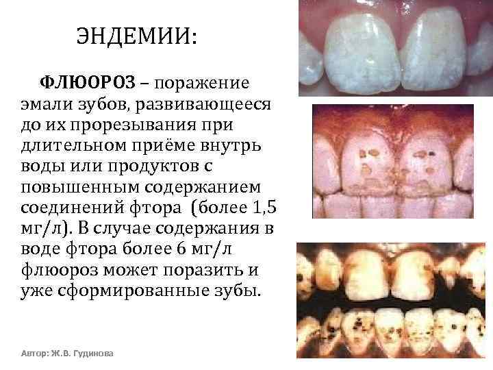ЭНДЕМИИ: ФЛЮОРОЗ – поражение эмали зубов, развивающееся до их прорезывания при длительном приёме внутрь
