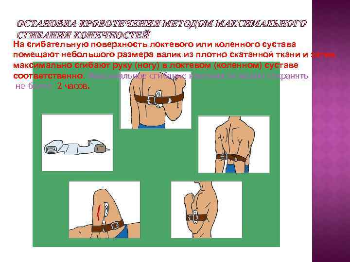 ОСТАНОВКА КРОВОТЕЧЕНИЯ МЕТОДОМ МАКСИМАЛЬНОГО СГИБАНИЯ КОНЕЧНОСТЕЙ На сгибательную поверхность локтевого или коленного сустава помещают