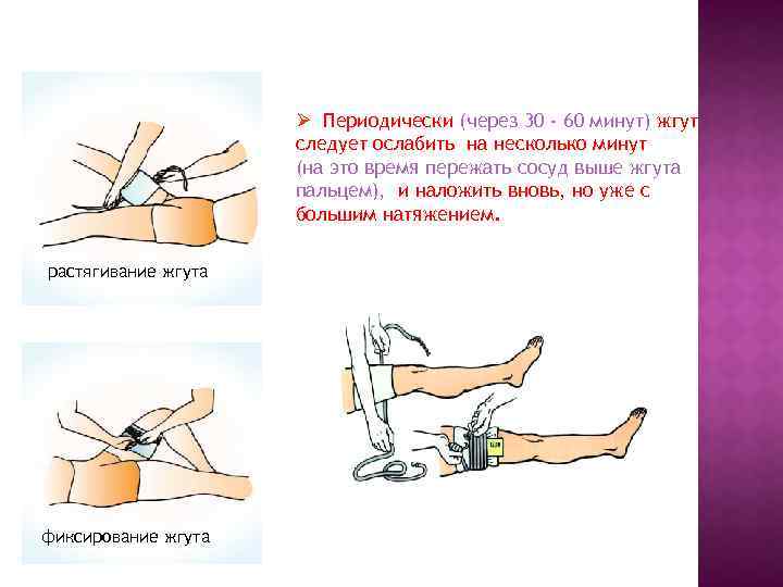 Ø Периодически (через 30 - 60 минут) жгут следует ослабить на несколько минут (на