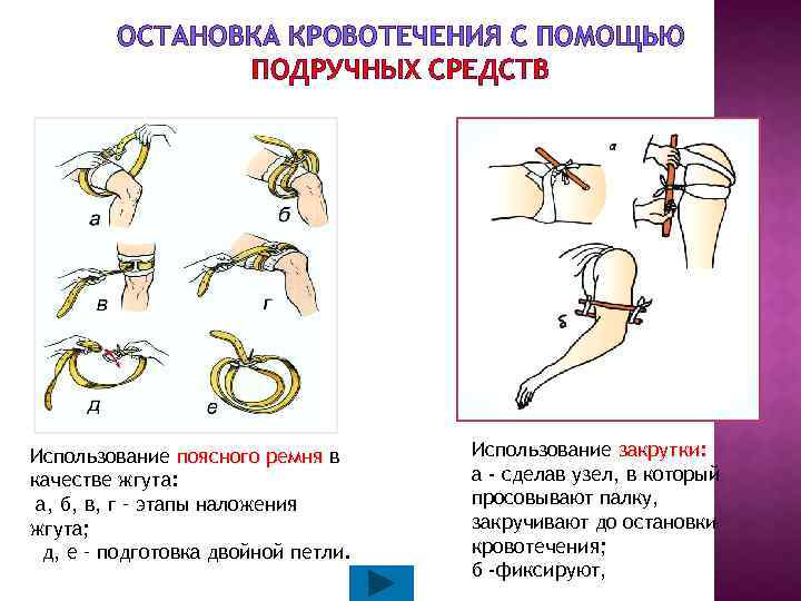 Рассмотрите изображение и определите какая ошибка совершена в данном случае при наложении жгута