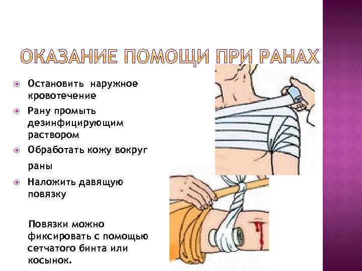 Повязки при кровотечениях. Давящая на кровотечении рану. Повязка на рану при кровотечении. Давящая повязка при наружном кровотечении. Обработать рану дезинфицирующим раствором наложить повязку.