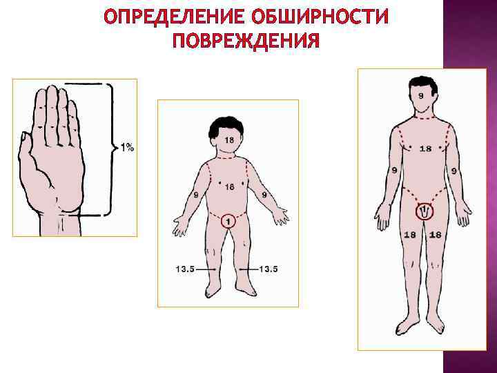 ОПРЕДЕЛЕНИЕ ОБШИРНОСТИ ПОВРЕЖДЕНИЯ 