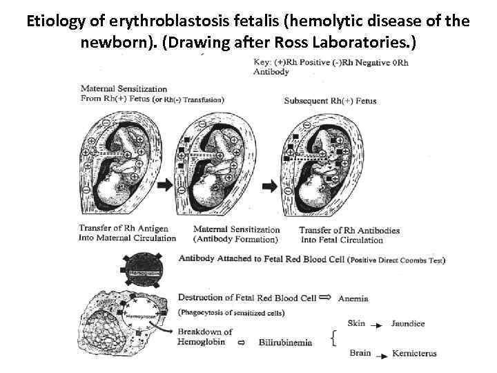 Etiology of erythroblastosis fetalis (hemolytic disease of the newborn). (Drawing after Ross Laboratories. )