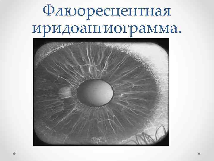 Флюоресцентная иридоангиограмма. 