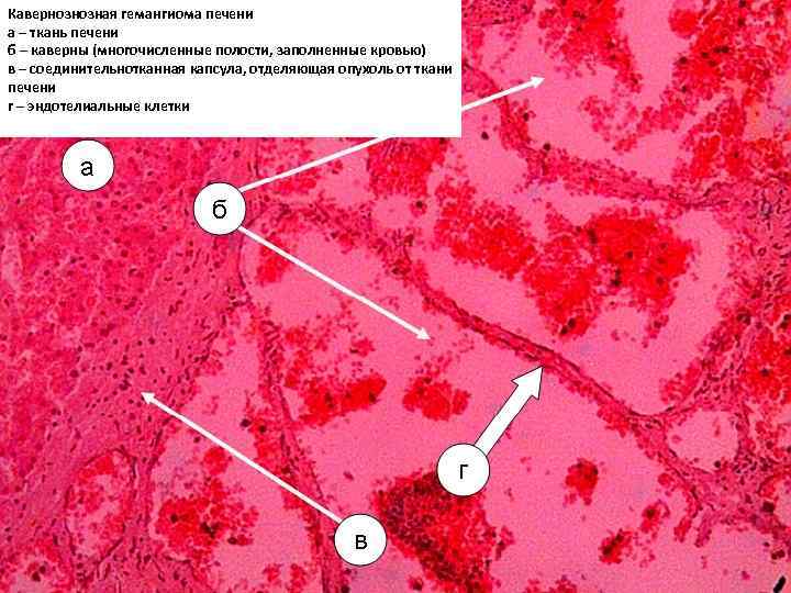 Кавернознозная гемангиома печени а – ткань печени б – каверны (многочисленные полости, заполненные кровью)