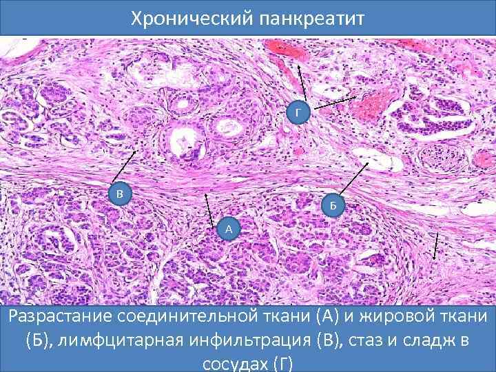 Хронический панкреатит Г В Б А Разрастание соединительной ткани (А) и жировой ткани (Б),