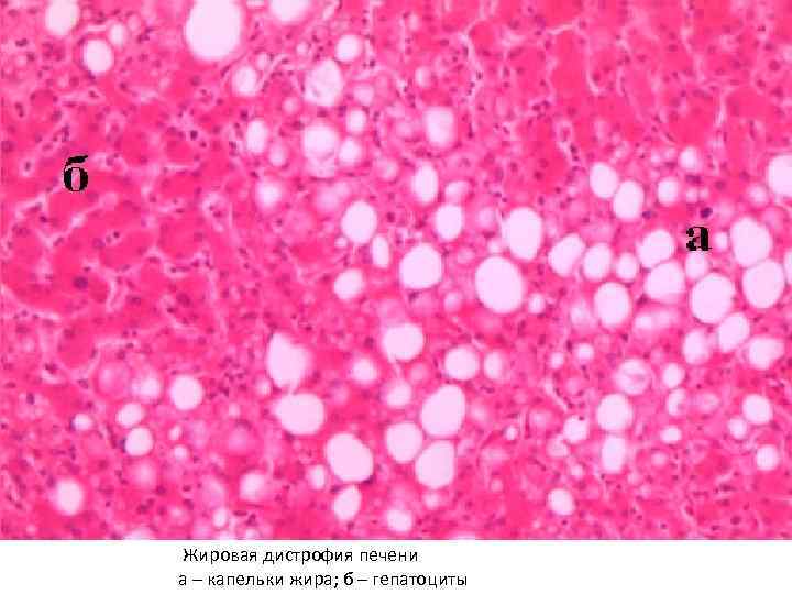 Жировая дистрофия печени а – капельки жира; б – гепатоциты 