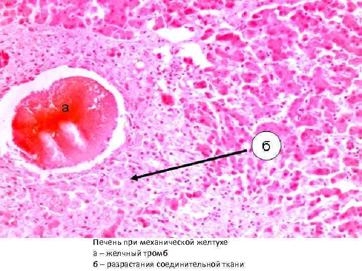 Печень при механической желтухе а – желчный тромб б – разрастания соединительной ткани 