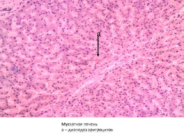 Мускатная печень а – диапедез эритроцитов 