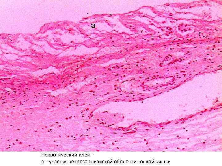 Некротический илеит а – участки некроза слизистой оболочки тонкой кишки 
