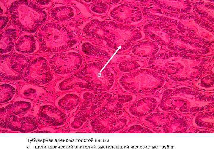 Тубулярная аденома толстой кишки а – цилиндрический эпителий выстилающий железистые трубки 